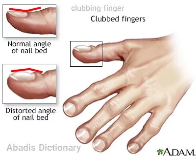 clubbing finger